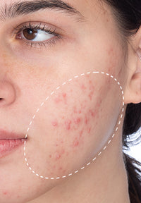 Acne Treatment Duo before and after images