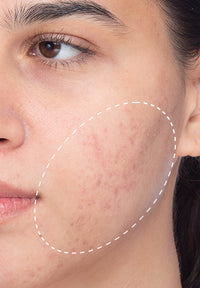 Acne Treatment Duo before and after images