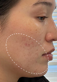 Acne Serum before and after images