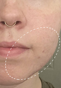 Acne Serum before and after images