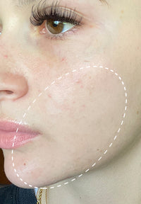Acne Serum before and after images