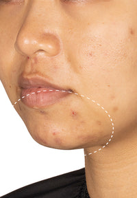 Acne Serum before and after images