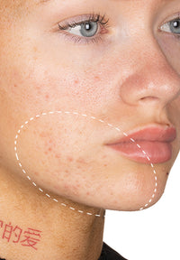 Acne Serum before and after images