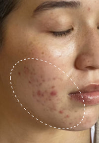 Acne Serum before and after images