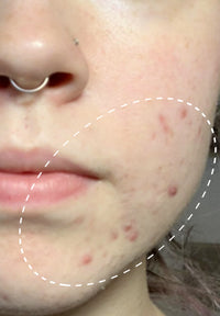 Acne Treatment Duo before and after images