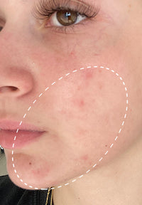 Acne Treatment Duo before and after images