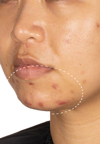 Acne Serum before and after images