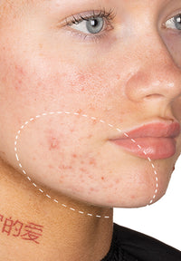 Acne Serum before and after images