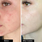 Acne Trio