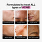 Acne Trio