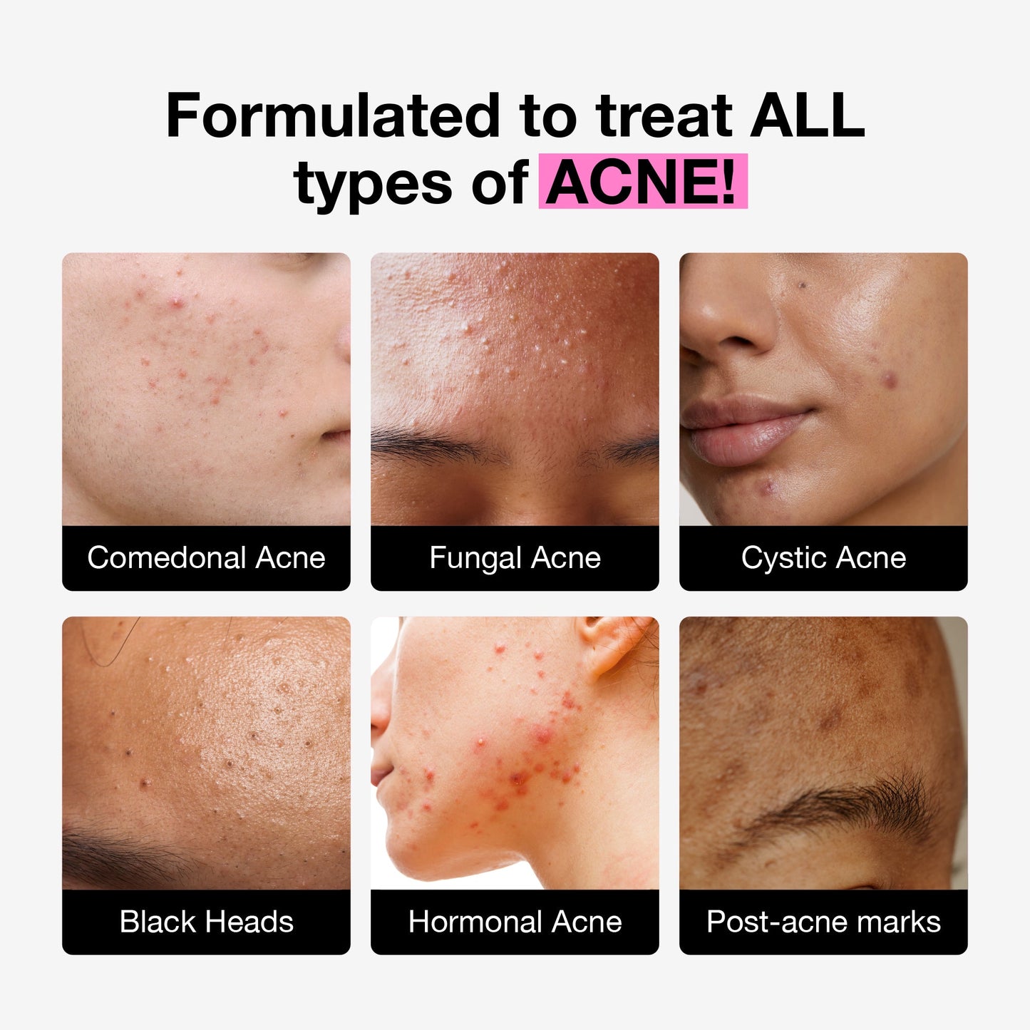 Acne Trio