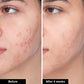 Acne Trio