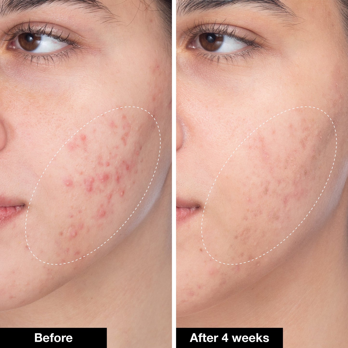 Acne Trio