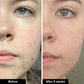 Acne Trio