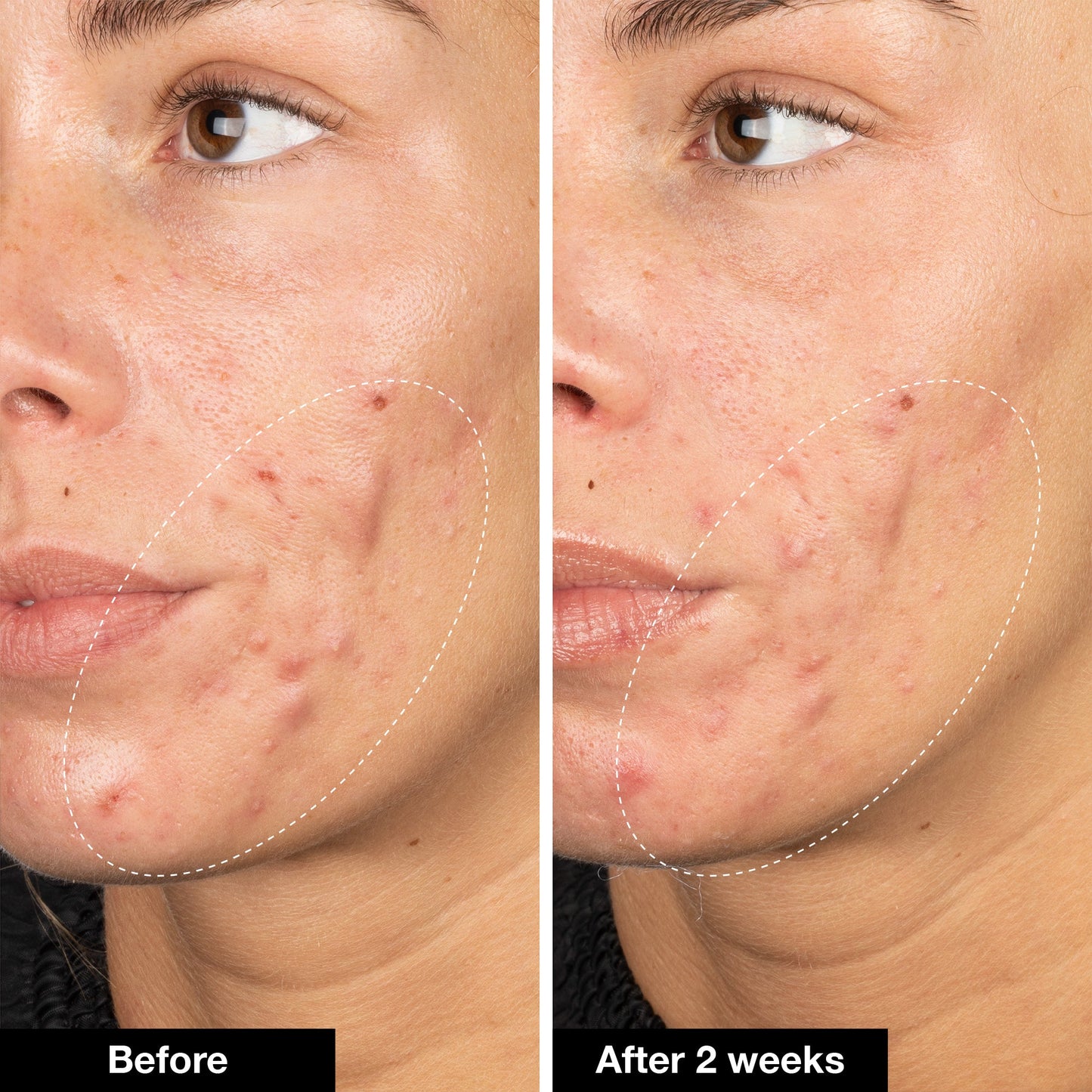Acne Trio