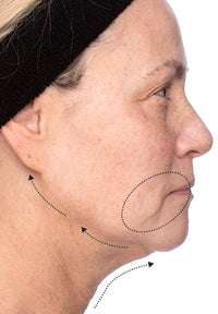 Elastic Skin before and after images
