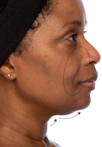 Elastic Skin before and after images