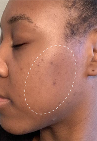 Retinol Remix 1% Retinol before and after images