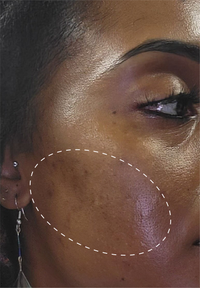 Retinol Remix 1% Retinol before and after images