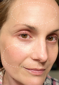 Retinol Remix 1% Retinol before and after images