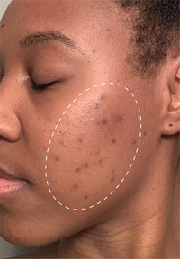 Retinol Remix 1% Retinol before and after images