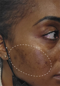 Retinol Remix 1% Retinol before and after images