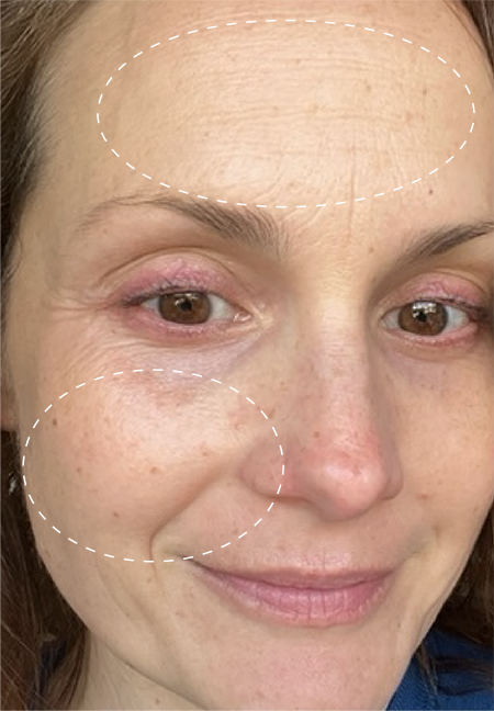 Retinol Remix 1% Retinol before