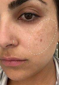 Retinol Remix 1% Retinol before and after images